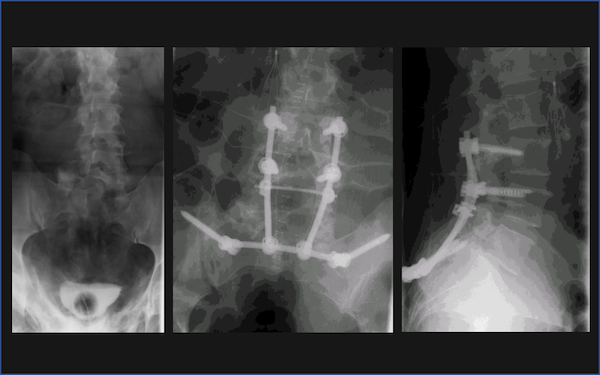 sacrum fracture and sex Perfect tits brunette
